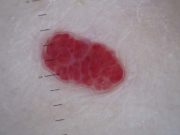 Hemangioma in Dogs: What Is It and What to Do About It? Hemangioma in Dogs - What Is It and What to Do About It featured image