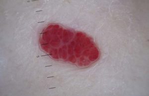 Hemangioma in Dogs: What Is It and What to Do About It? Hemangioma in Dogs - What Is It and What to Do About It featured image