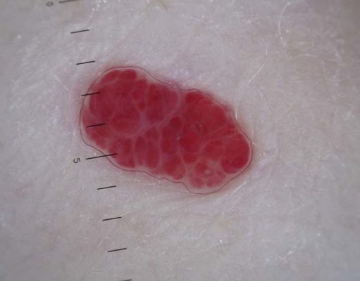 Hemangioma in Dogs: What Is It and What to Do About It? Hemangioma in Dogs - What Is It and What to Do About It featured image