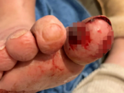 Dog Chomps Its Owner’s Toe to Save His Life dog chomps owners toe