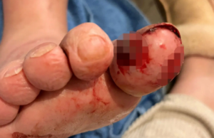 Dog Chomps Its Owner’s Toe to Save His Life dog chomps owners toe