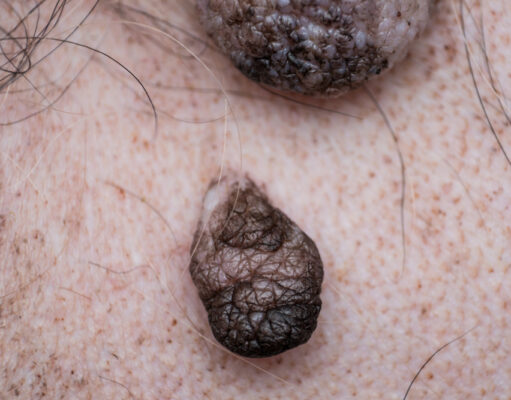 What Do Cancer Moles on Dogs Look Like? Cancer moles on dogs - as seen on a dog's belly